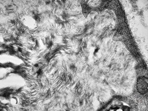 F,8y. | metachromatic leukodystrophy - n. suralis F,8y. | metachromatic leukodystrophy - n. suralis